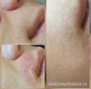 Электроэпиляция - Казань